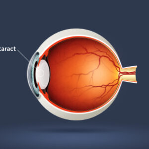 Cataract