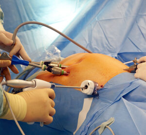 Laparoscopy