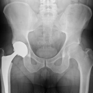 Hip Replacement